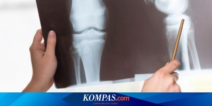 Osteoporosis: Penyebab dan Cara Mencegahnya sejak Dini