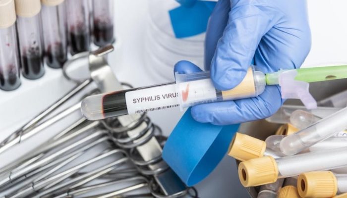 Tanda Tanda Sifilis Berdasarkan Tahapan Waspadai Sejak Dini
